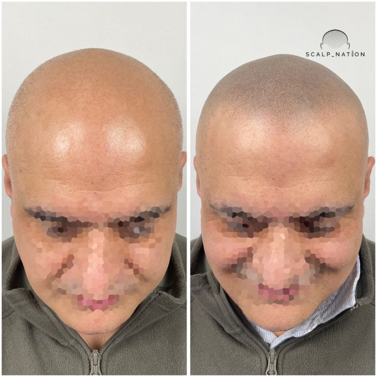 Scalp Micropigmentation Transformation Before And After