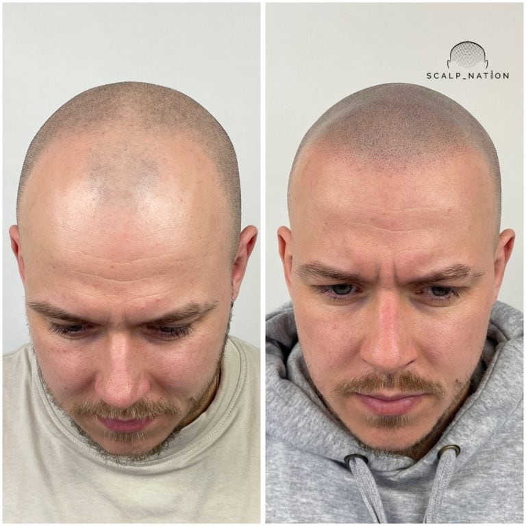 Scalp Micropigmentation Transformation Before And After