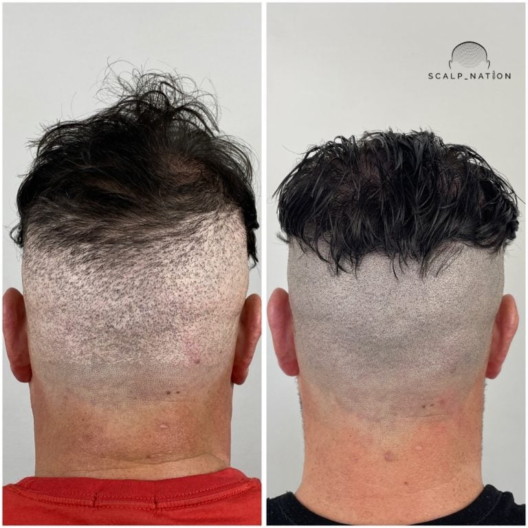 Scalp Micropigmentation Transformation Before And After