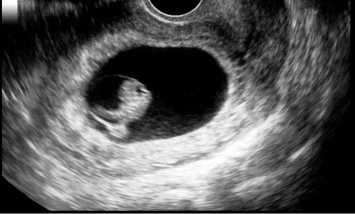 Early Pregnancy