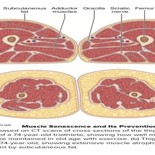 Photo Describing Healthy Muscles Vs Sedentary Muscles Atrophy