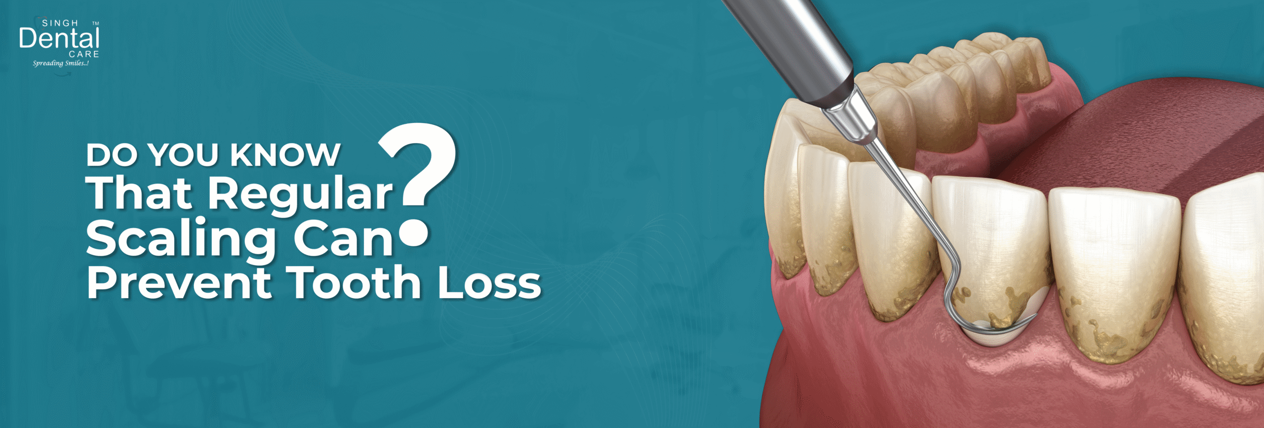 Did You Know That Regular Scaling Can Prevent Tooth Loss!