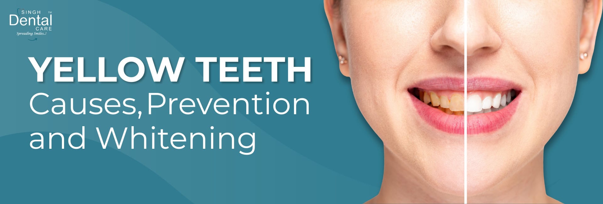 Yellow Teeth Causes and Prevention: How to Whiten Teeth Safely & Effectively