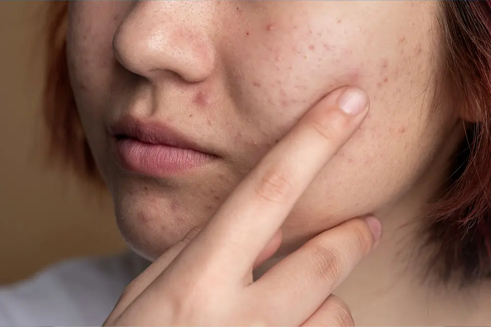 Acne treatment