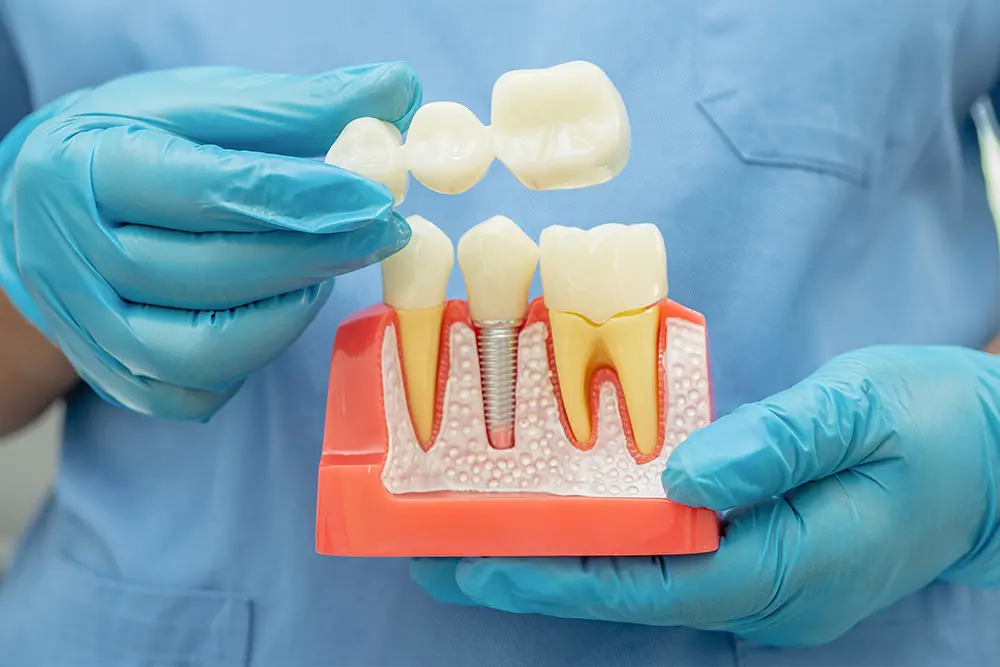 Dental crowns and bridges