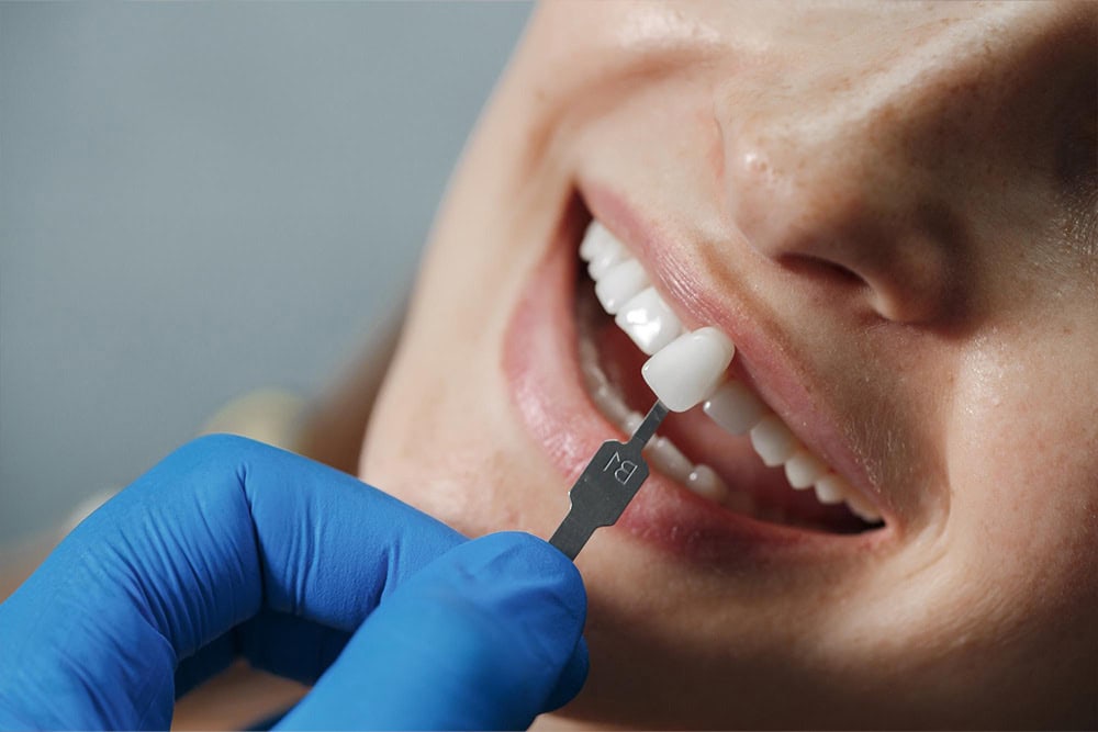 Dental veneers