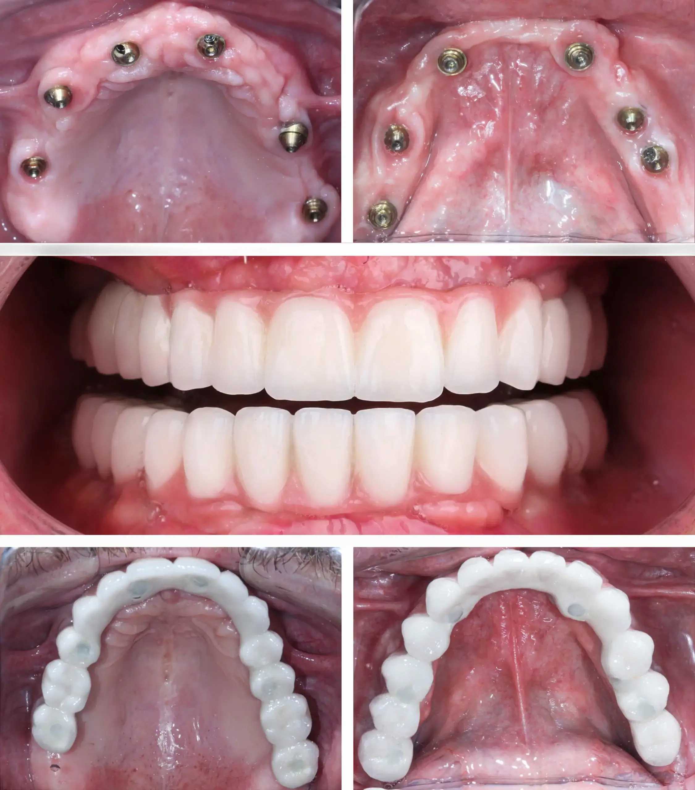 Patient smiling confidently after complete smile transformation at Team Dental