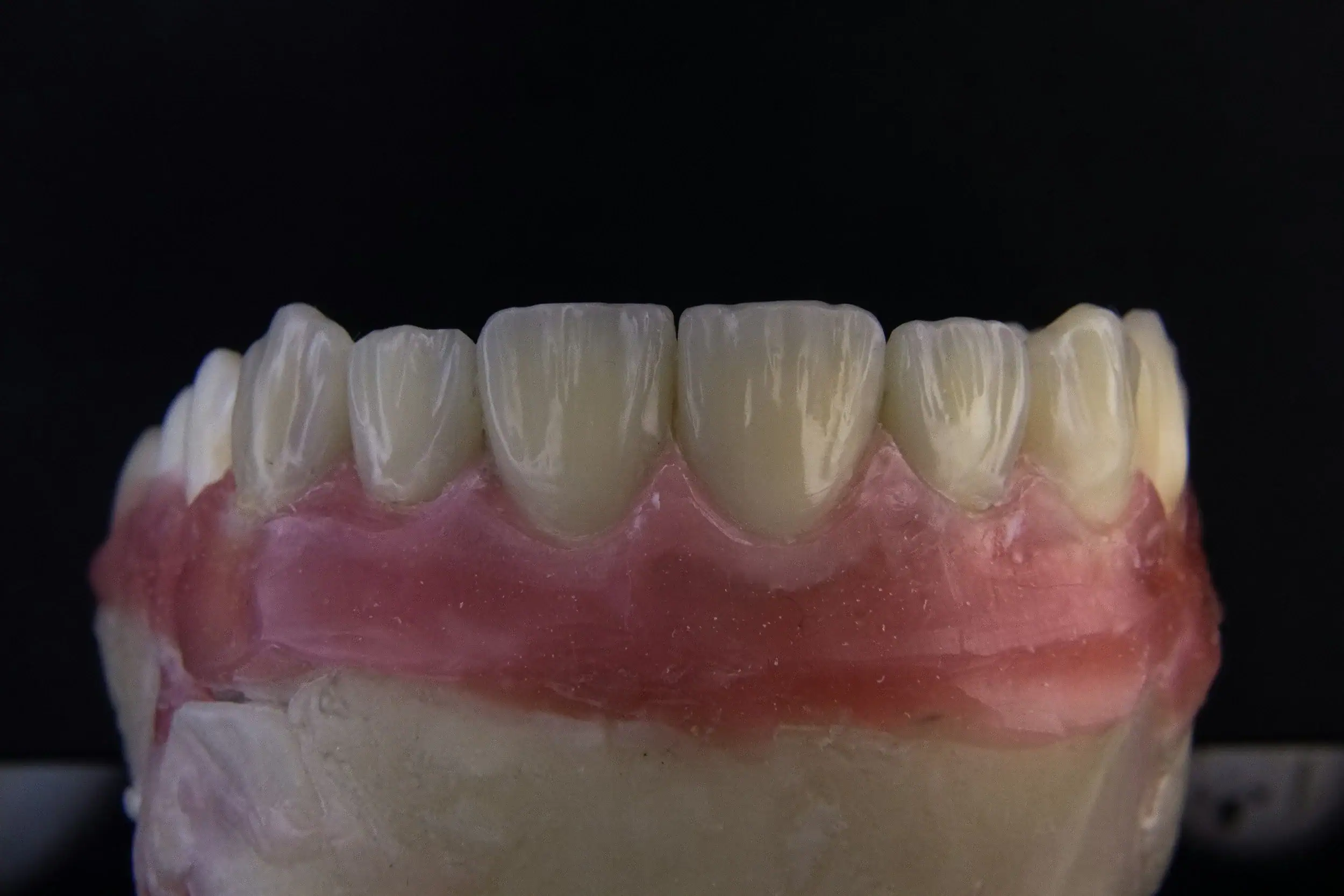 For Sandy's Lower Teeth: