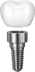 All-on-X Dental Implants