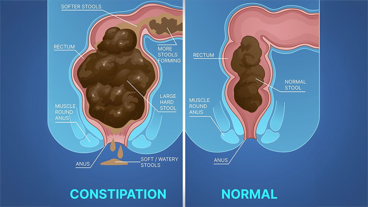 side-by-side-diagram-comparing-constipated-and-normal-bowel-movements