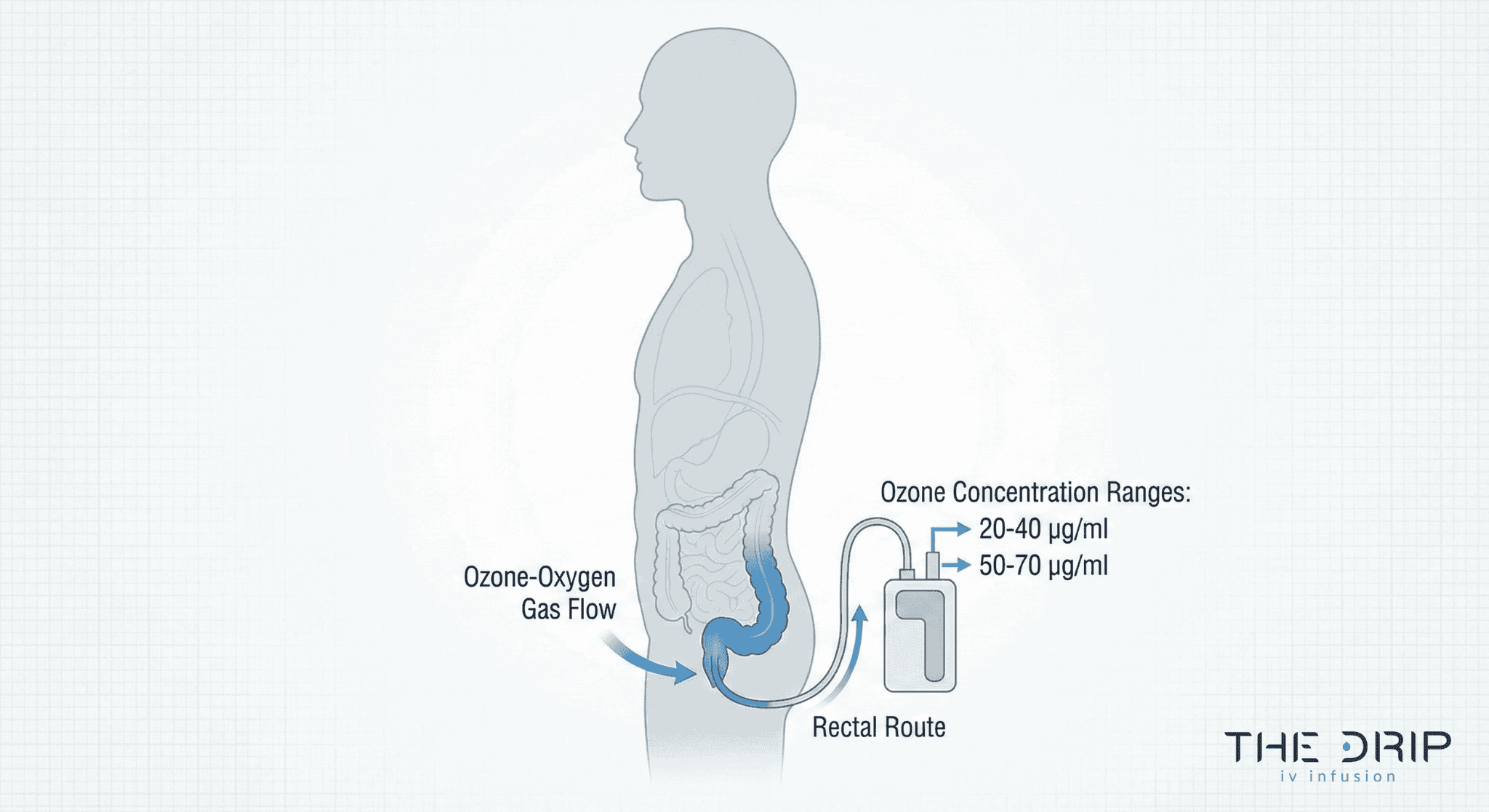 Medical illustration of ozone therapy using rectal insufflation with labeled dosage ranges.