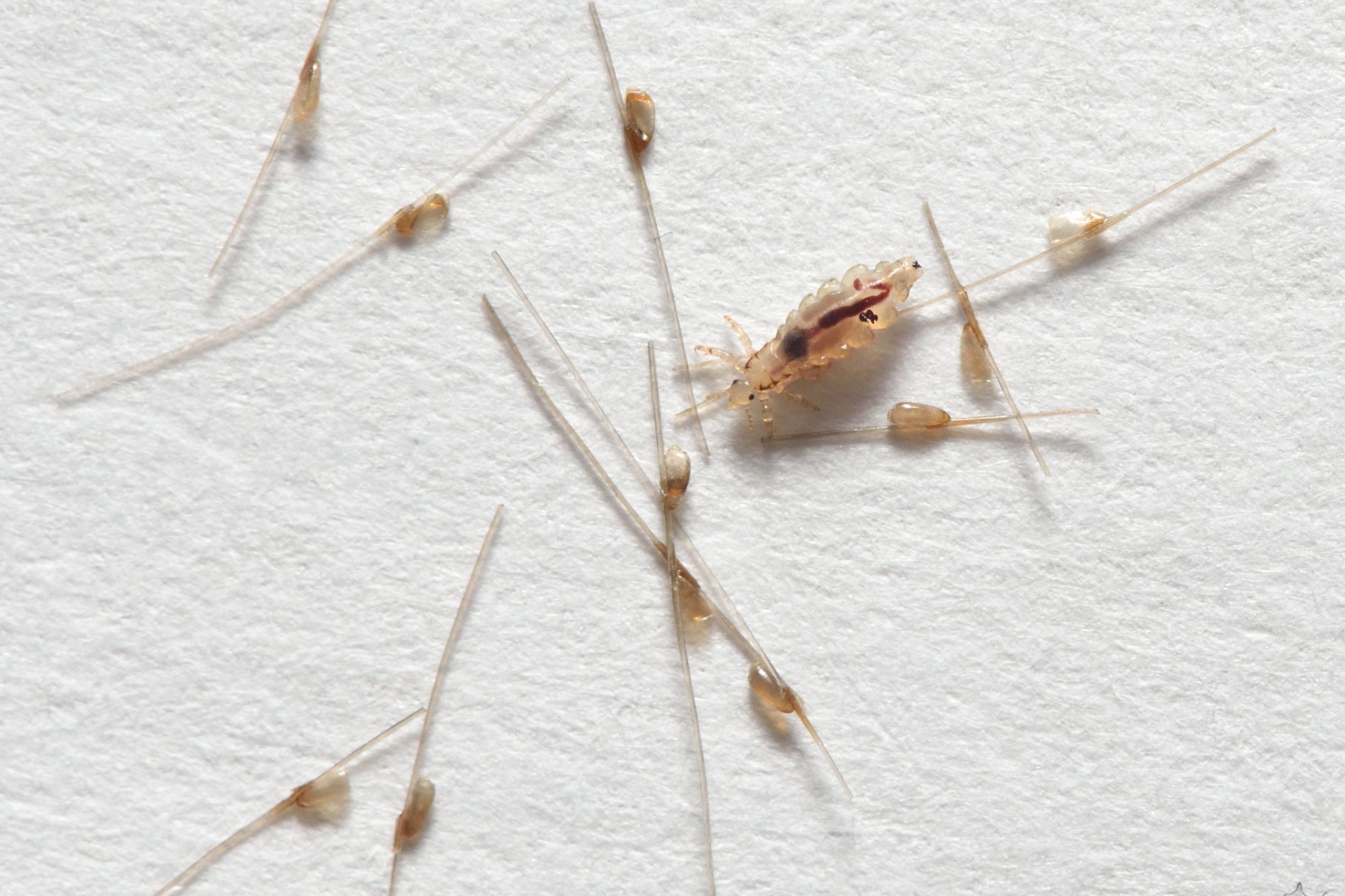 lice eggs (nits) on hair. Pals lice treatmenting viriginia beach