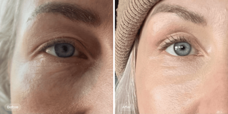 Plexr Plus Treatment in Regina to Brighten Your Skin