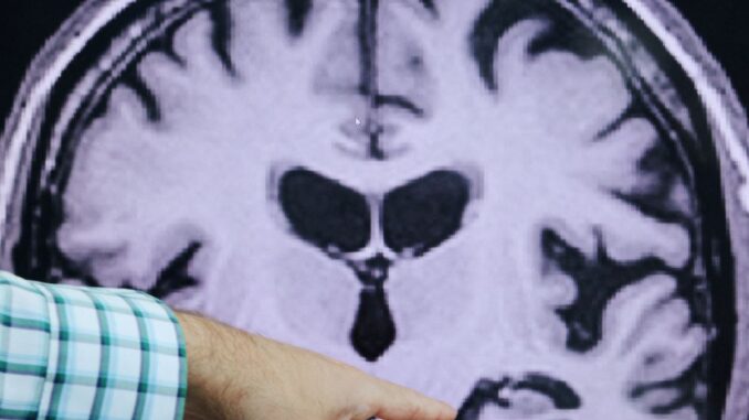 quest-diagnostics-launches-alzheimers-blood-test-for-consumers.jpg Quest Diagnostics launches Alzheimer’s blood test for consumers