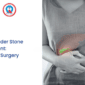 Gallbladder Stone Treatment Laser vs Surgery 85x85