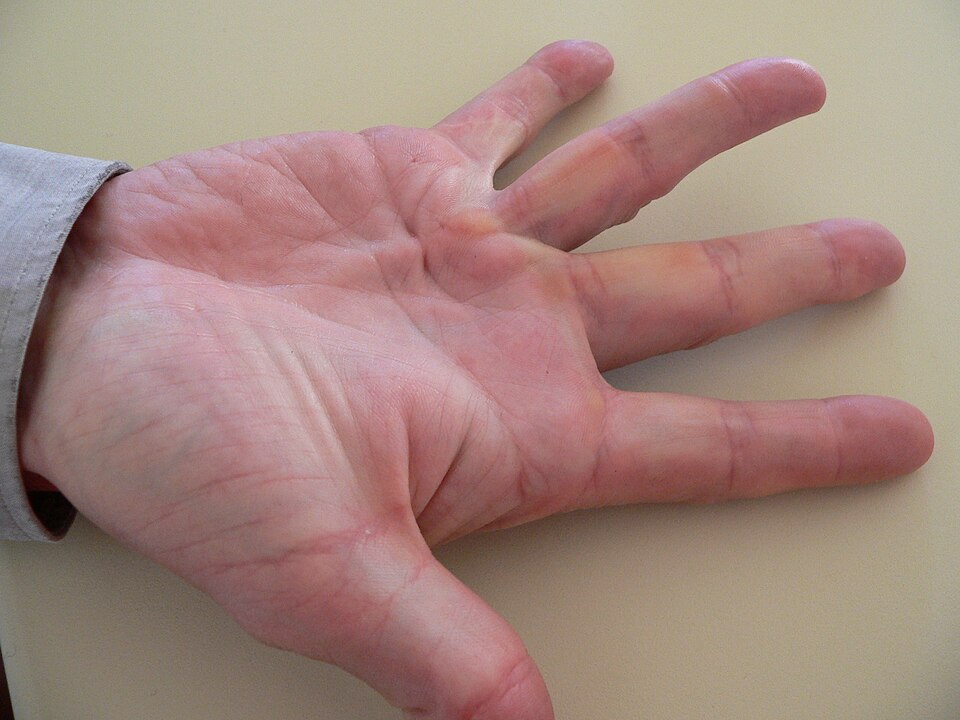 Dupuytren's contracture hand deformity