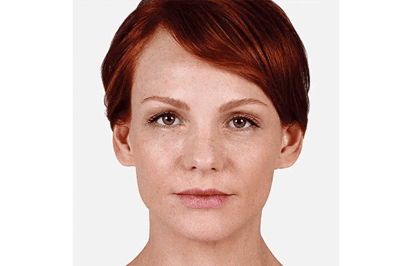 Juvederm - Image 4