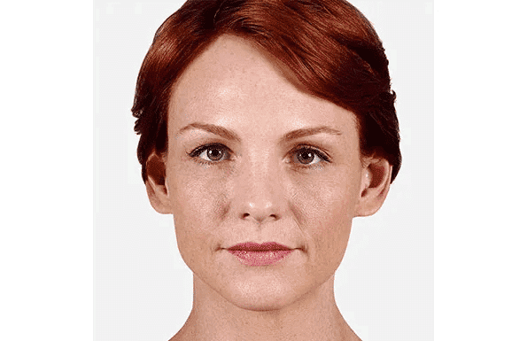 Juvederm - Image 3