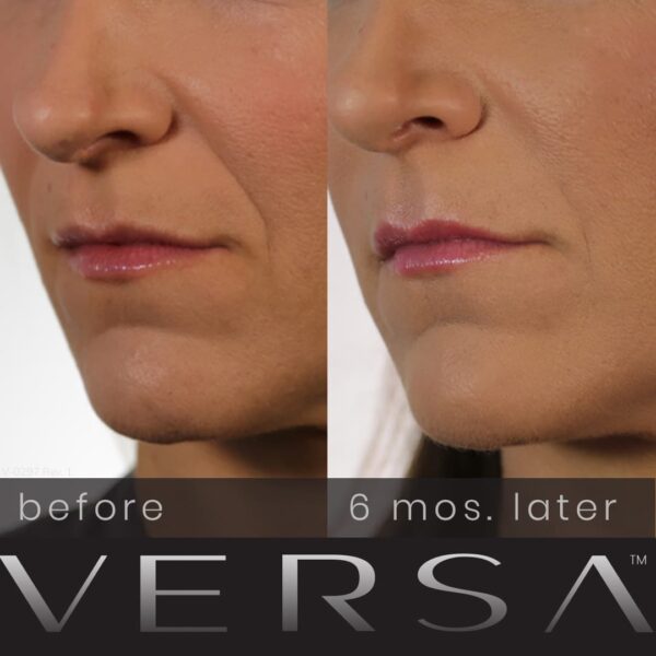 Revanesse Versa - Filler - Image 3