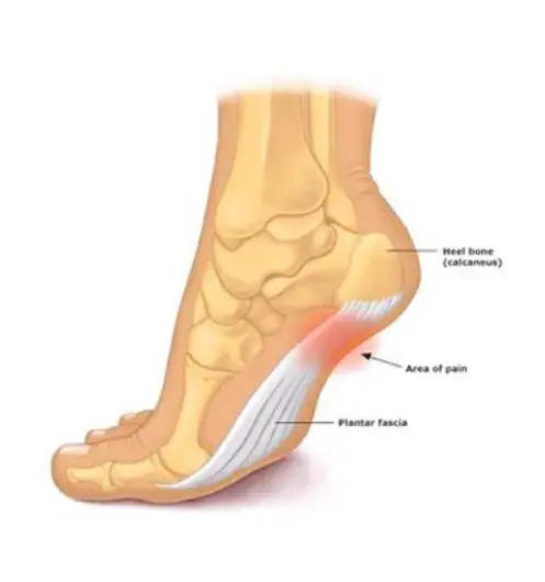 plantar fasciitis pain relief Honolulu, HI