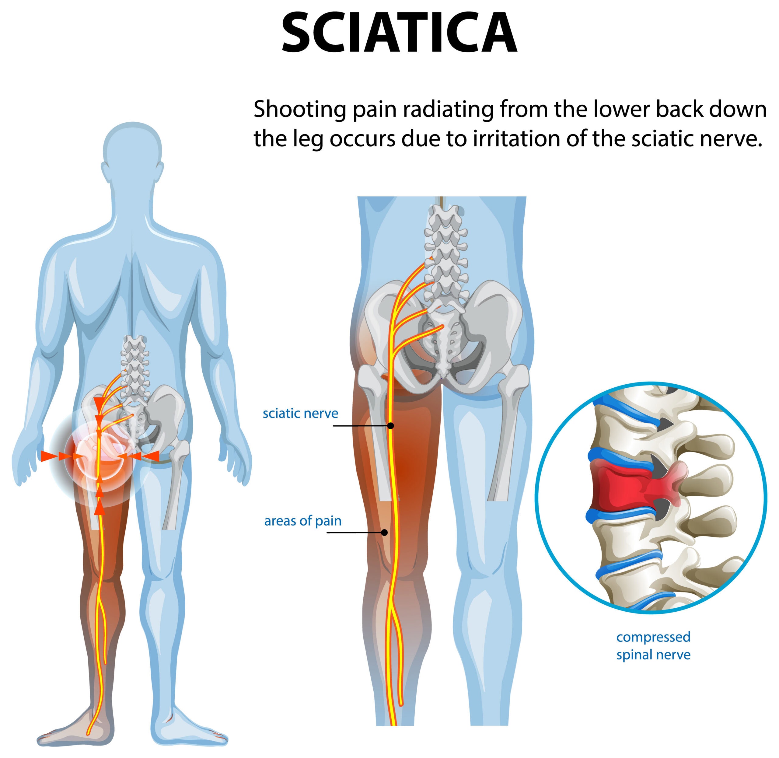 scitica pain diagram with anatomy hoola chiropractic scitica treatment honululu
