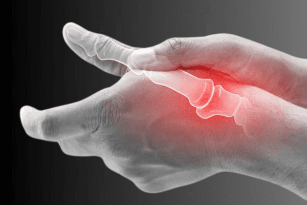 Arthritis