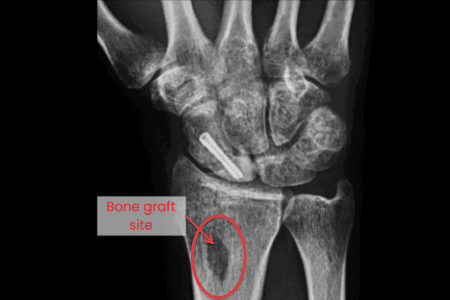 Bone grafting (For severe fractures)