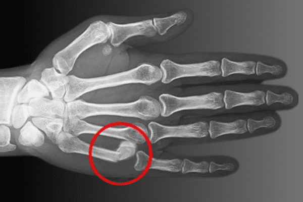 Boxer’s fracture