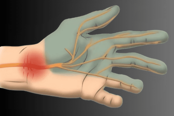 Carpal tunnel syndrome
