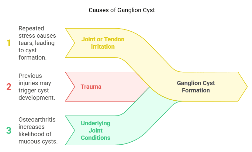 Causes of ganglion cyst