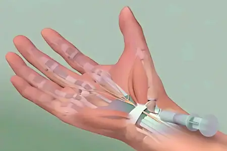 Corticosteroid injections