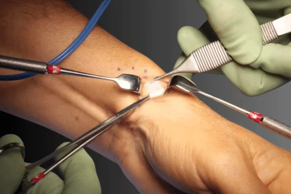 De quervain’s release surgery
