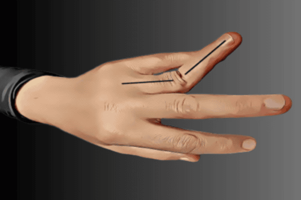 Dislocations of fingers or thumb