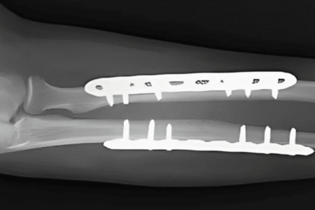 Fracture fixation (Internal fixation)