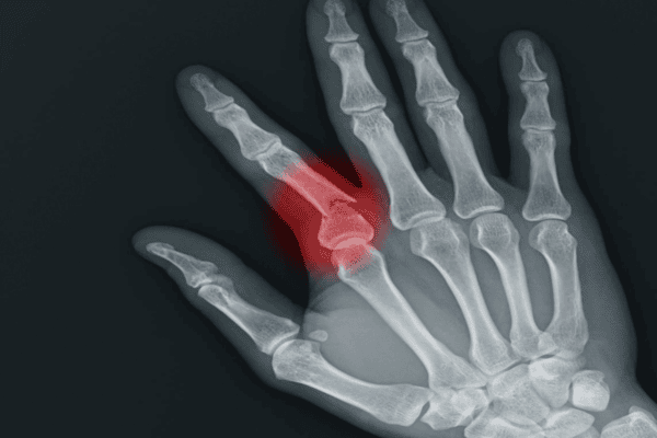 Fractures (Fingers or Thumb)