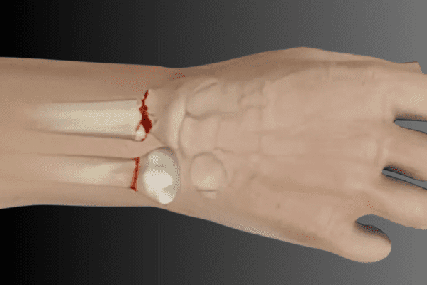 Fractures or Sprains