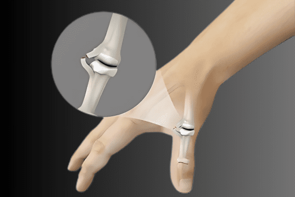 Gamekeeper’s thumb (Skier’s thumb)