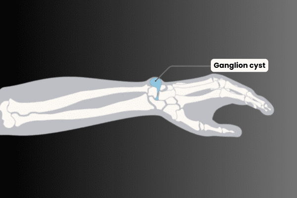 Ganglion cyst