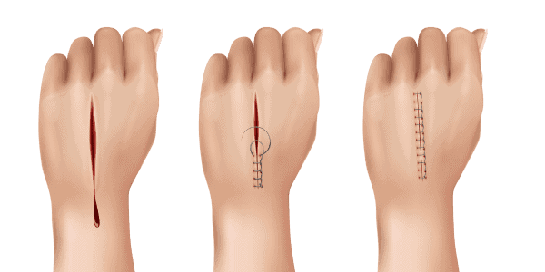 Hand Microsurgery