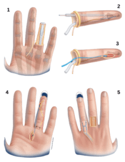 Hand Replantation