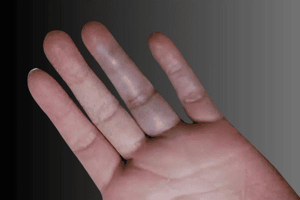 Jammed fingers (Sprained or Dislocated fingers)