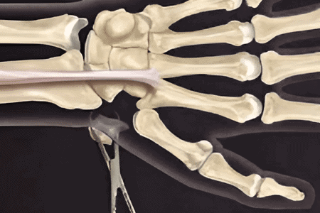 Ligament reconstruction