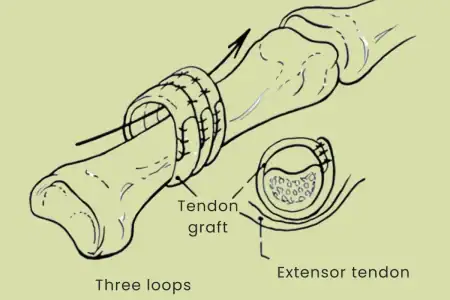 Reconstruction of pulley system