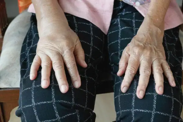 Swollen or Stiff fingers
