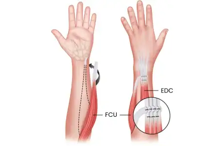 Tendon transfer
