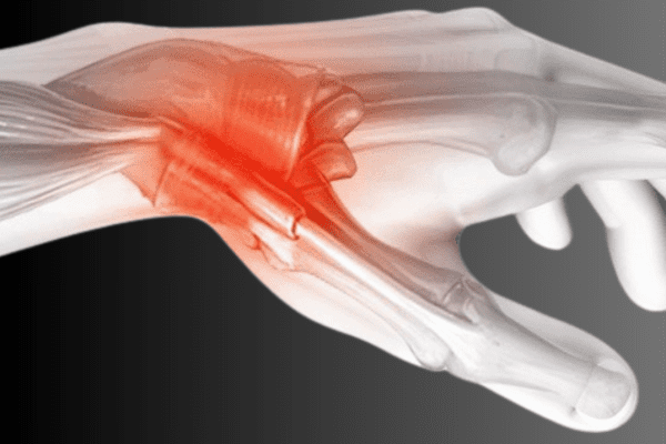 Tendonitis (De Quervain’s Tenosynovitis)