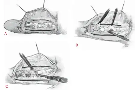Tenolysis