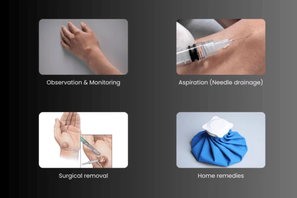 Treatment options for ganglion cysts
