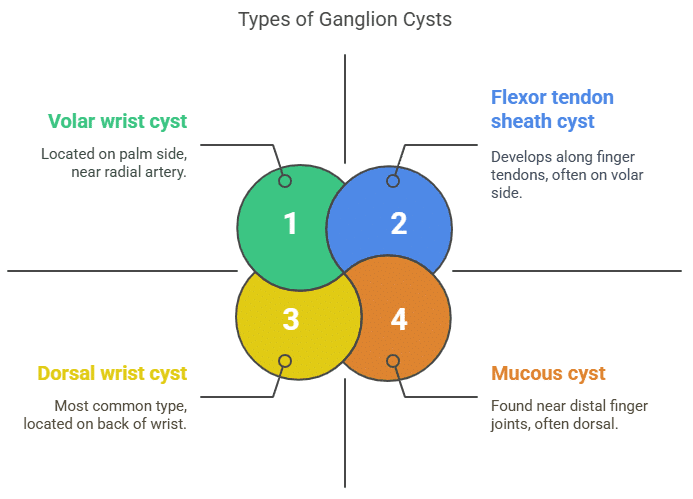 Types of ganglion cyst