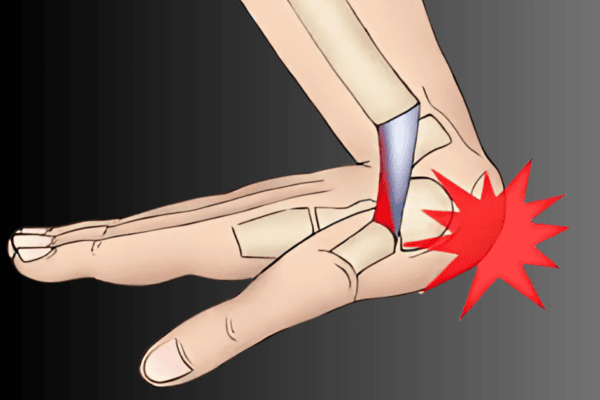 Wrist sprains or Ligament injuries